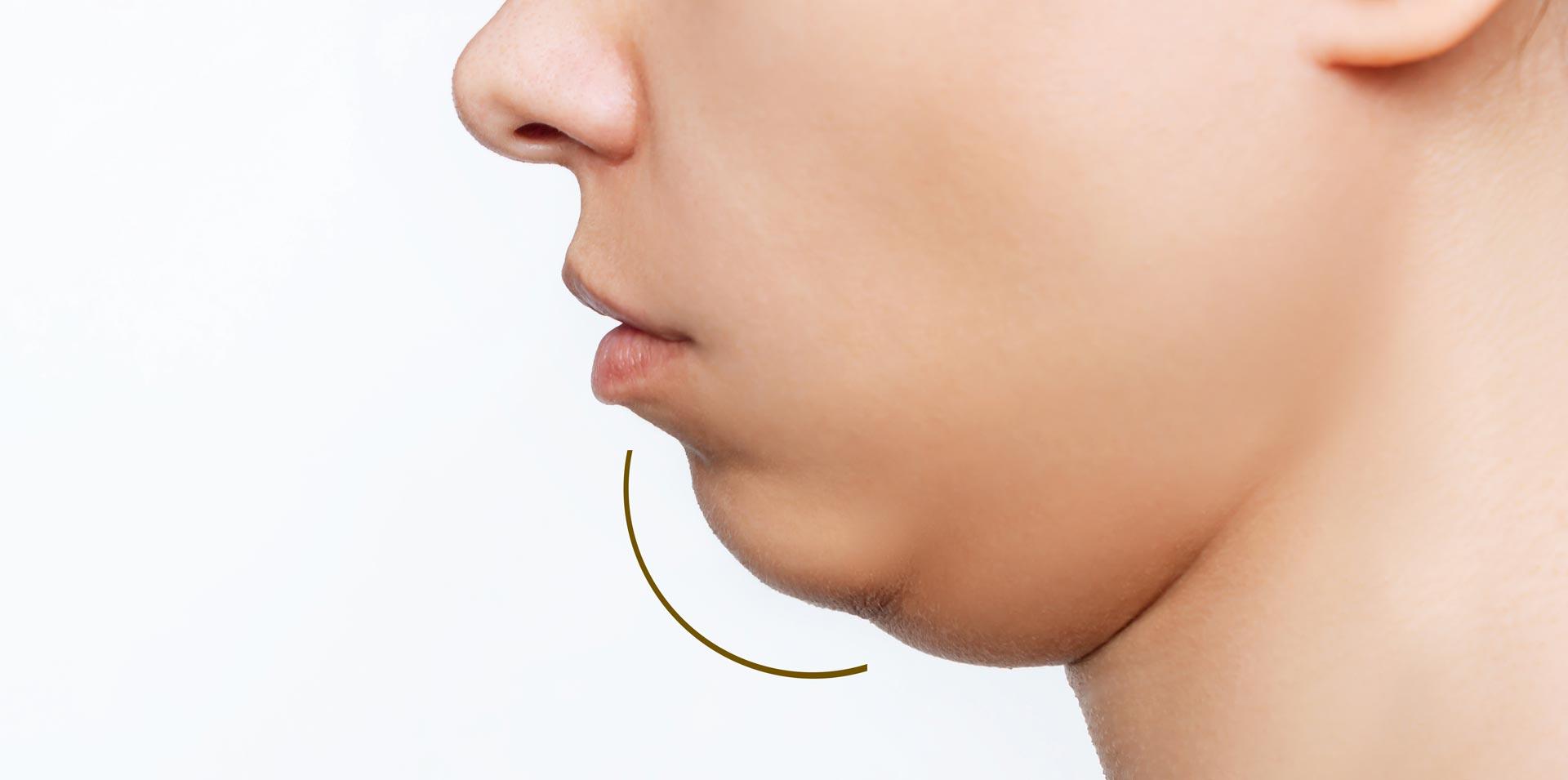 Chin-Augmentation