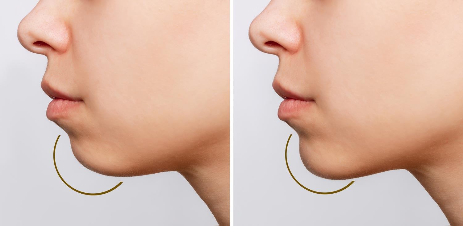 Chin-Augmentation