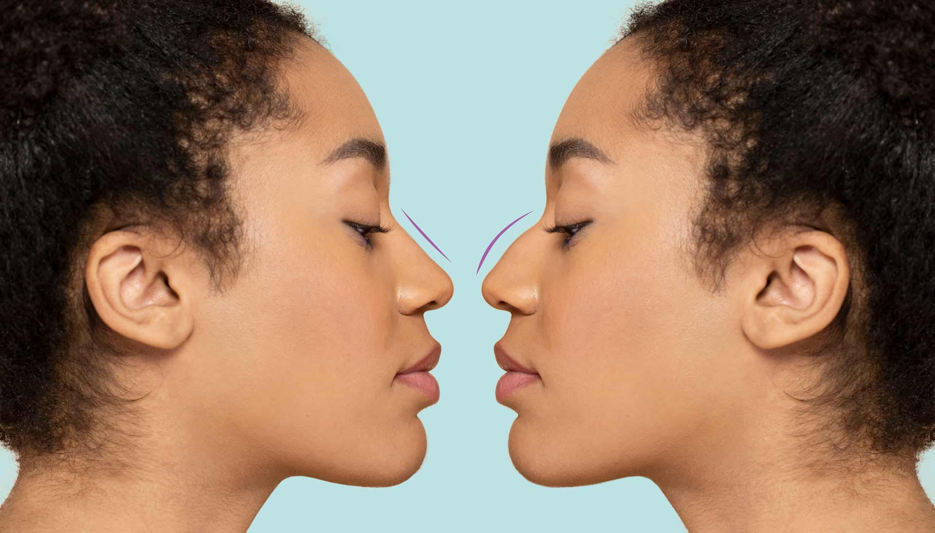 Rhinoplasty Surgery