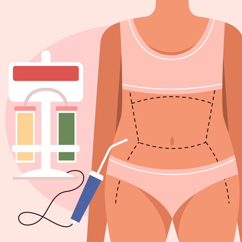 VASER Liposuction