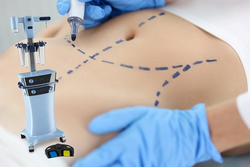 Comparing VASER With Other Fat Removal Options